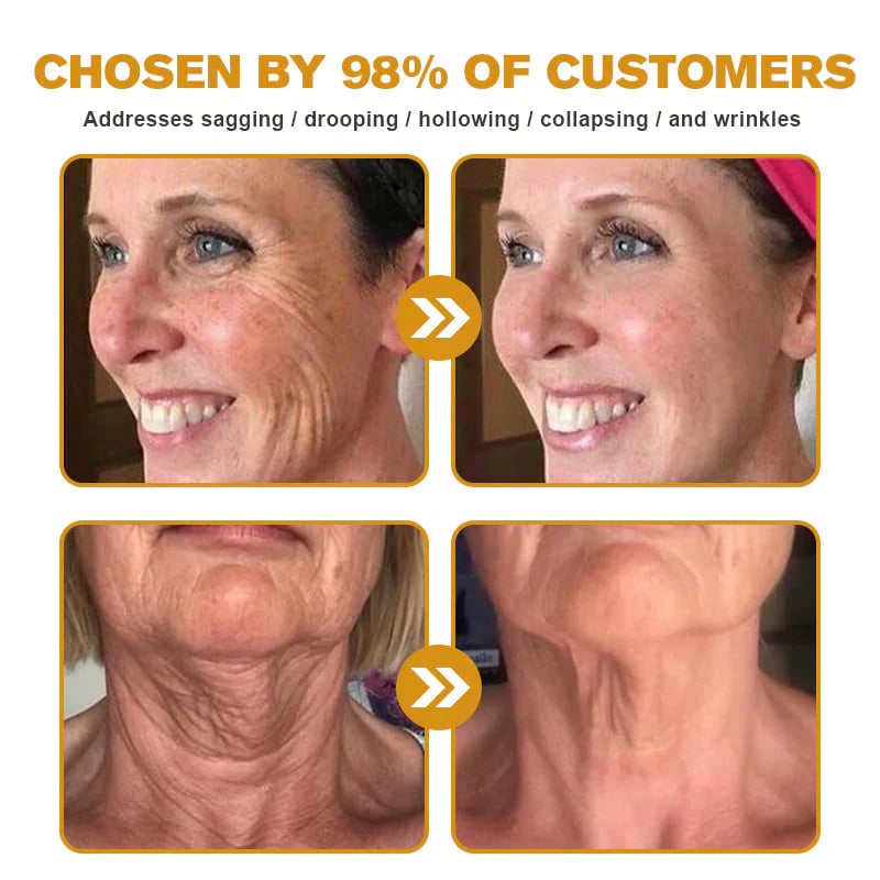 ✨ Smooth Wrinkles Without Botox – 49% OFF – 🌿 Bee Venom Wrinkle Removal Cream – Lift, Firm & Rejuvenate 💖